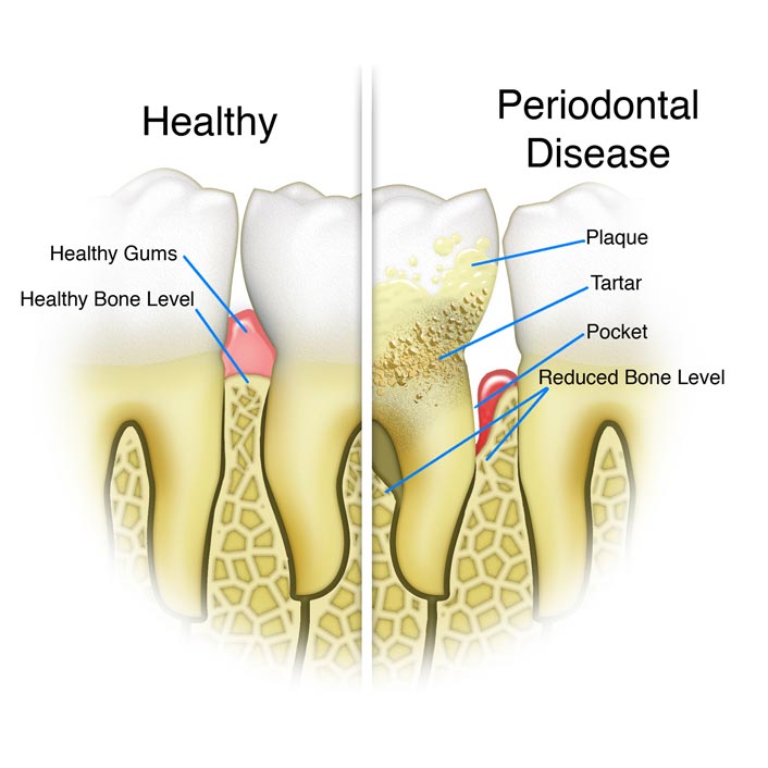 Periodontal (Gum) Treatments