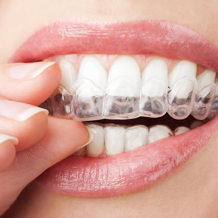 Invisalign